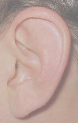 Otopexie, Technik der Ohranlegung bei Abstehenden Ohren Ohrenkorrektur Ohroperation Ohr Korrektur